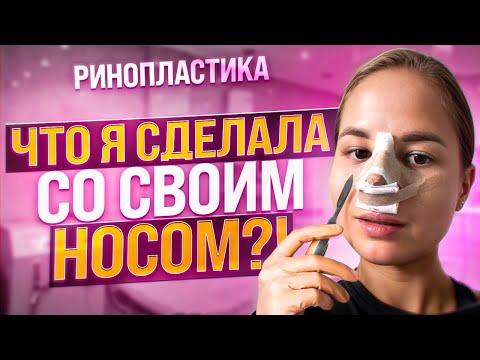 РИНОПЛАСТИКА: как меня развели врачи / как я неделю не могла дышать