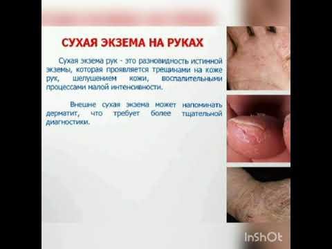 ЭКЗЕМА зоболевание кожи #как избавиться от экземы#лечение экземы